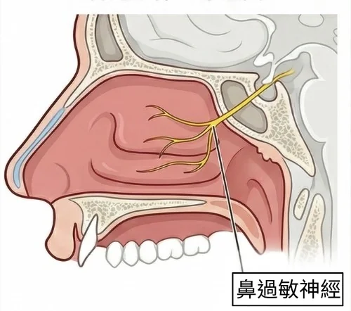 鼻過敏神經阻斷（翼管神經）手術示意圖