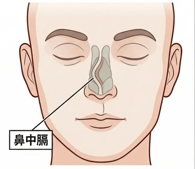 鼻中膈彎曲矯正手術示意圖