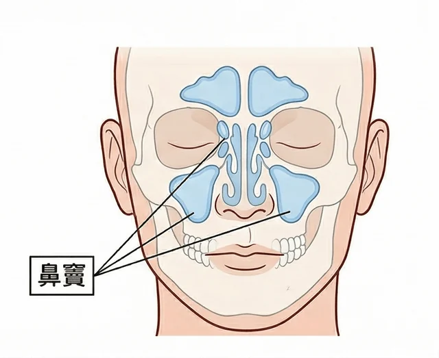 鼻竇內視鏡微創手術示意圖